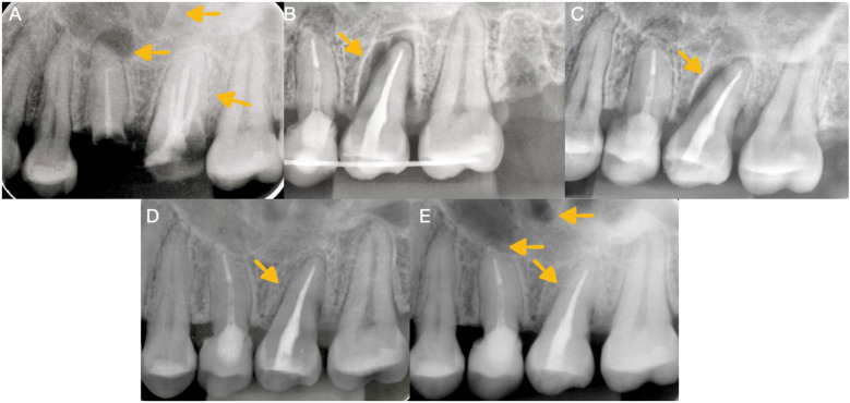 Case Report: Dental autotransplantation for the resolution of odontogenic sinusitis using 3D replication.