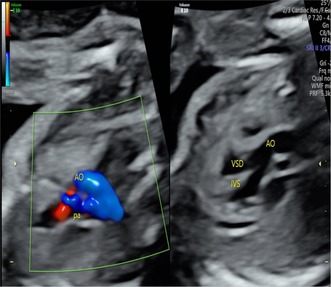 Compound Heterozygous Loss-of-Function Variants in CCM2L in a Fetus With Tetralogy of Fallot.