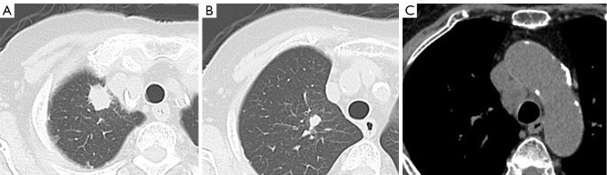 Needle tract seeding after endobronchial ultrasound-guided intranodal forceps biopsy and cryobiopsy: a case report.