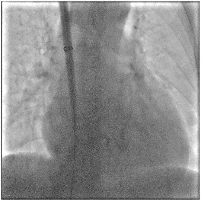 Right Internal Jugular Vein Access for Micra Leadless Pacemaker Implantation in a High-Risk Patient with Severe Iliac Vein Stenosis: A Case Report.
