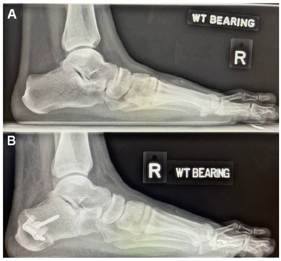 Autograft vs Allograft With Bone Marrow Aspirate Concentrate as an Osteotomy Gap Filler in Lateral Column Lengthening for Progressive Collapsing Flatfoot Deformity.