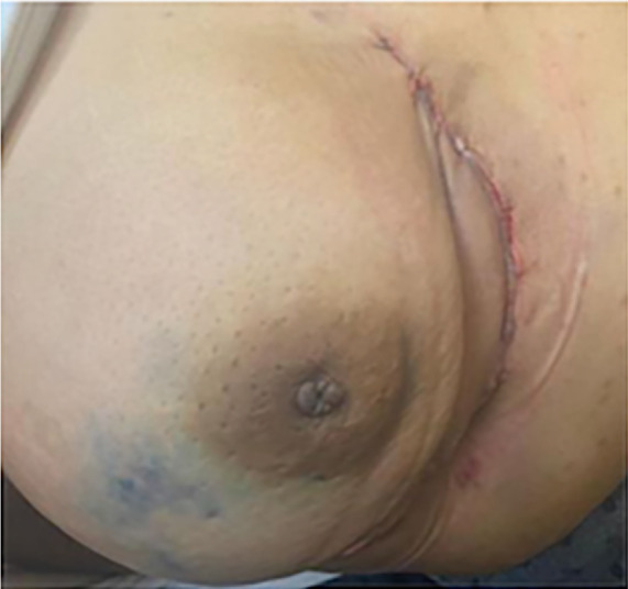 Evaluation of Perforator Fasciocutaneous Flaps for Oncoplastic Immediate Reconstruction Following Breast Conservative Surgery in Lower and Lateral Breast Quadrant Lesions Perforator Fasciocutaneous Flaps for OBCS.