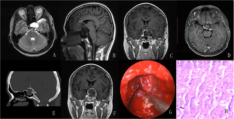 EEA for sellar chodrosarcomas: case series with literature review.