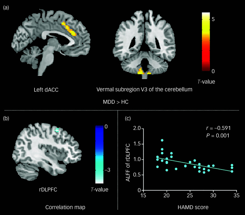 Alterations of cerebral intrinsic activity in first-episode, drug-naive patients with major depressive disorder.