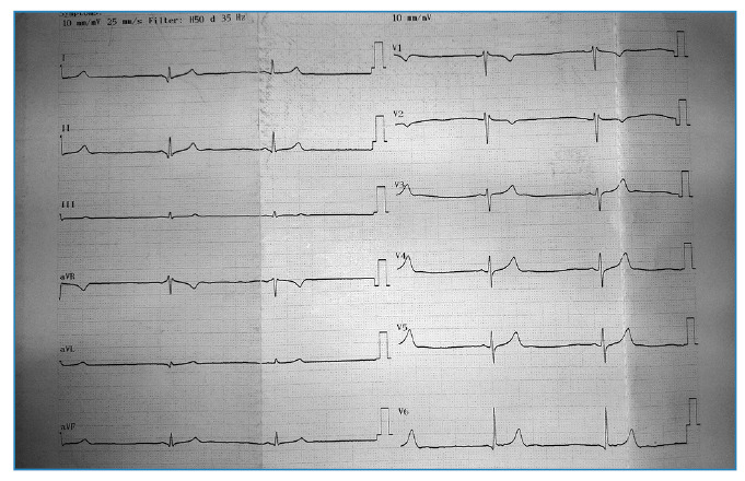 Crimean-Congo hemorrhagic fever with severe bradycardia treated with Theophylline.