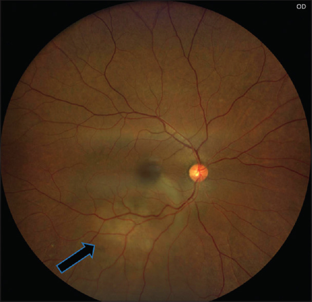 Central serous chorioretinopathy mimicking as choroidal hemangioma - A diagnostic challenge.
