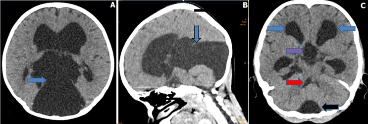 Unusual hydrocephalus from retrocerebellar arachnoid cyst sparing the fourth ventricle.