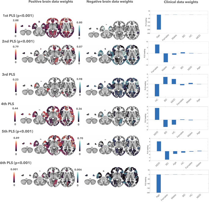 Multivariate brain morphological patterns across mood disorders: key roles of frontotemporal and cerebellar areas.