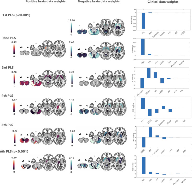 Multivariate brain morphological patterns across mood disorders: key roles of frontotemporal and cerebellar areas.