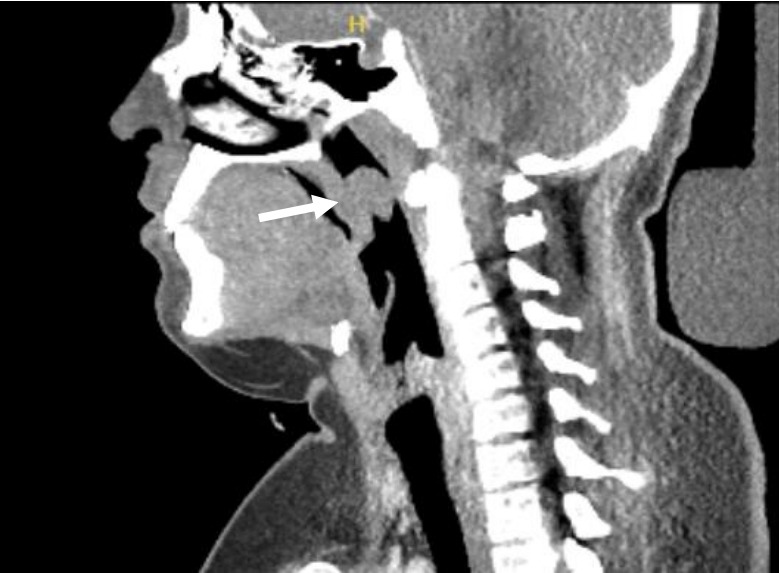 Peripheral nerve sheath tumors in the head and neck in patients with APC gene deletion mutations: a case report and scoping review of the literature.