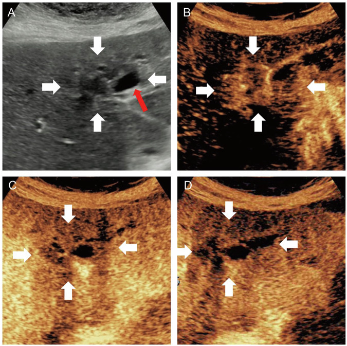 Association between ultrasound-based biliary and parenchymal intrahepatic mass-forming cholangiocarcinoma subtypes and clinicopathological features and survival.