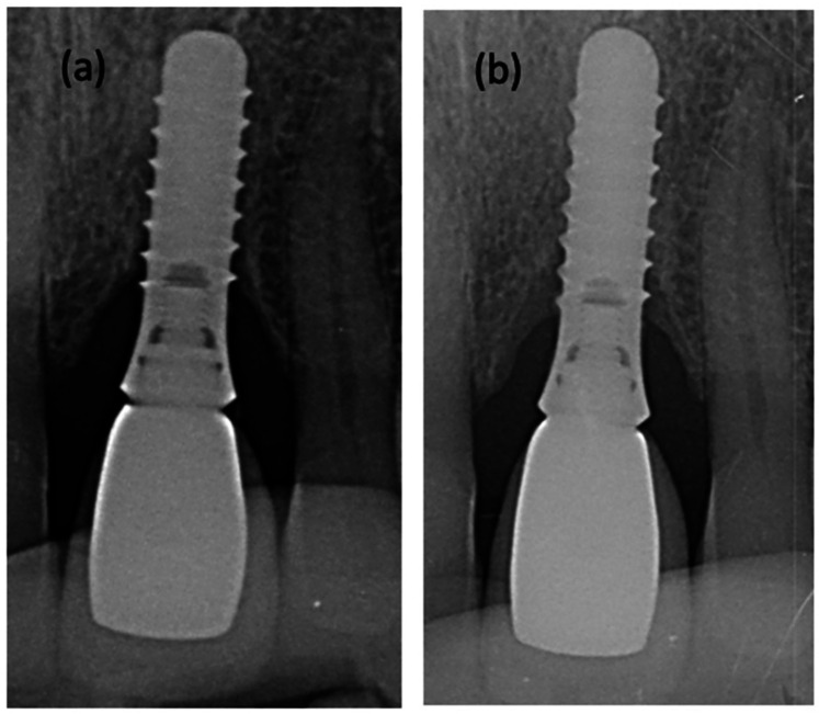 A prospective evaluation of subgingival irrigation with i-PRF following non-surgical treatment of peri-implantitis.