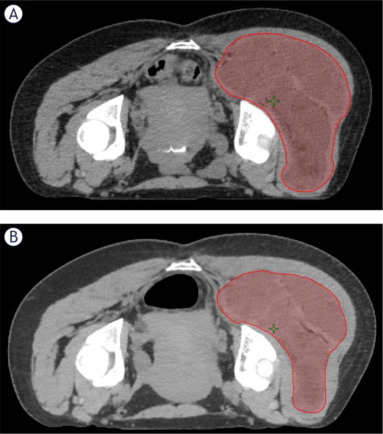 Radiographic and pathologic response of myxoid liposarcoma treated with preoperative radiotherapy.