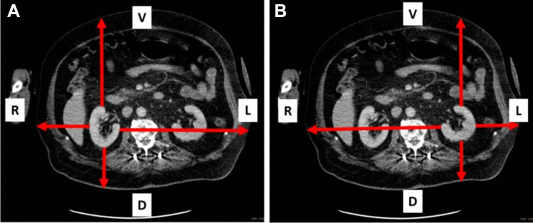 Development of a CT-less SPECT Acquisition Protocol for Kidney Dosimetry in <sup>177</sup>Lu-PSMA-617 Radioligand Therapy.
