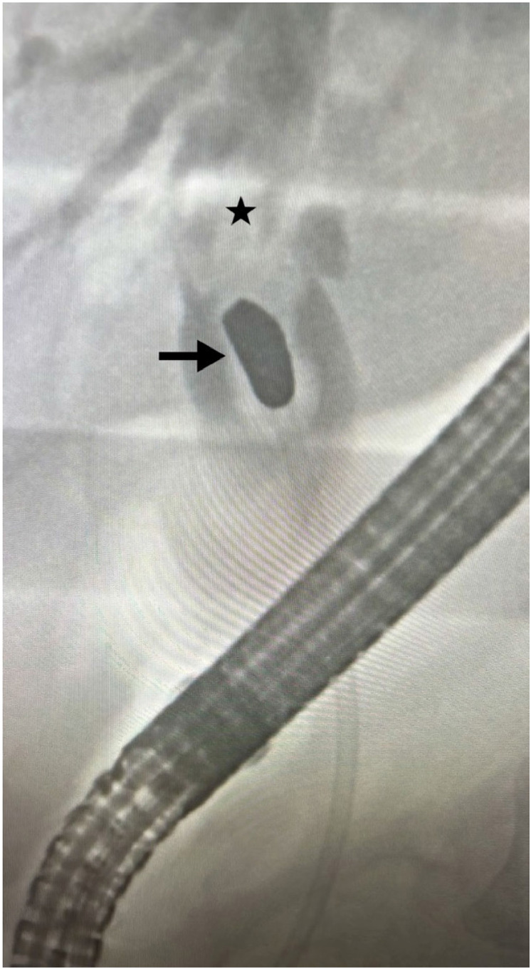 Management of obstructive jaundice induced by a retained bullet in the common hepatic duct: A case report.
