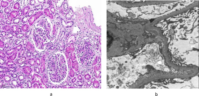 Successful outcome of a refractory IgA vasculitis nephritis in children treated with telitacicept.