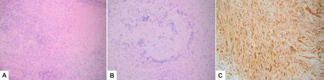 Peripheral nerve sheath tumors in the head and neck in patients with APC gene deletion mutations: a case report and scoping review of the literature.
