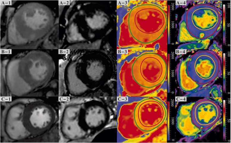 Effect of obesity on myocardial tissue characteristics in patients with hypertrophic cardiomyopathy: a cardiovascular magnetic resonance-based study.