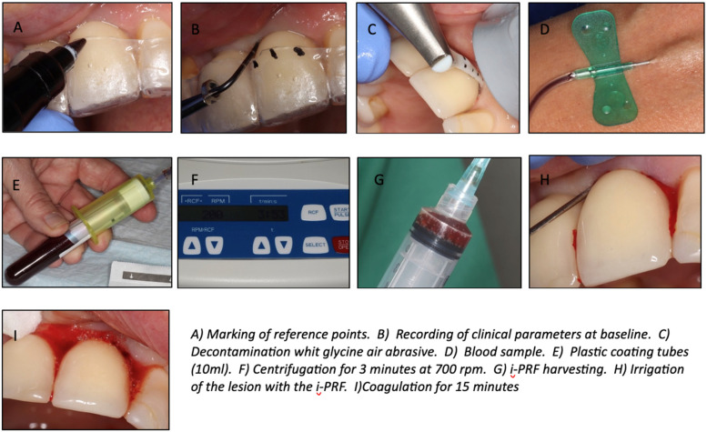 A prospective evaluation of subgingival irrigation with i-PRF following non-surgical treatment of peri-implantitis.