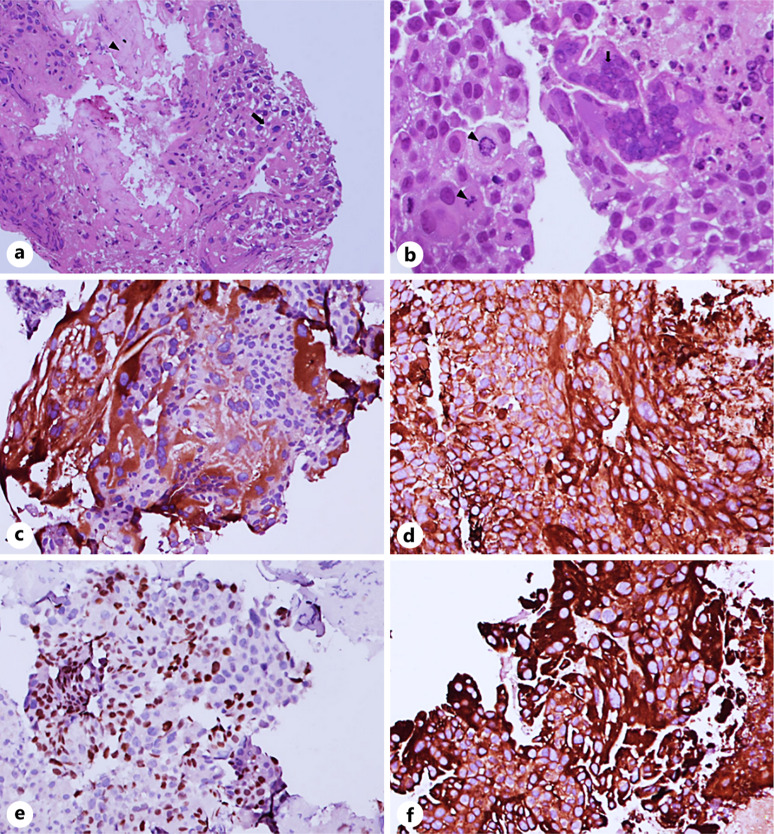Remarkable Response to Cisplatin-Based Chemotherapy and Long-Term Remission in a Young Male with Widespread Extragonadal Choriocarcinoma: A Case Report and Literature Review.