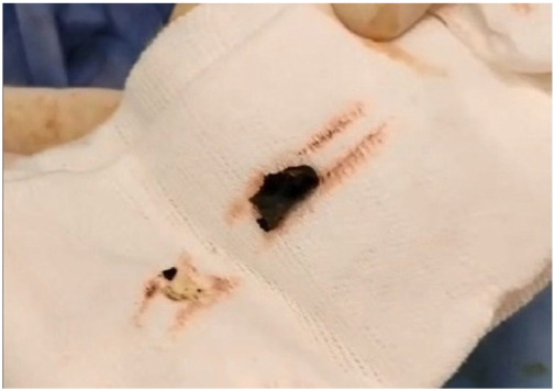 Management of obstructive jaundice induced by a retained bullet in the common hepatic duct: A case report.
