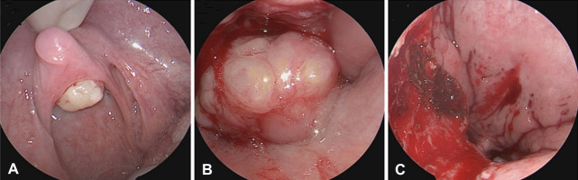 Peripheral nerve sheath tumors in the head and neck in patients with APC gene deletion mutations: a case report and scoping review of the literature.