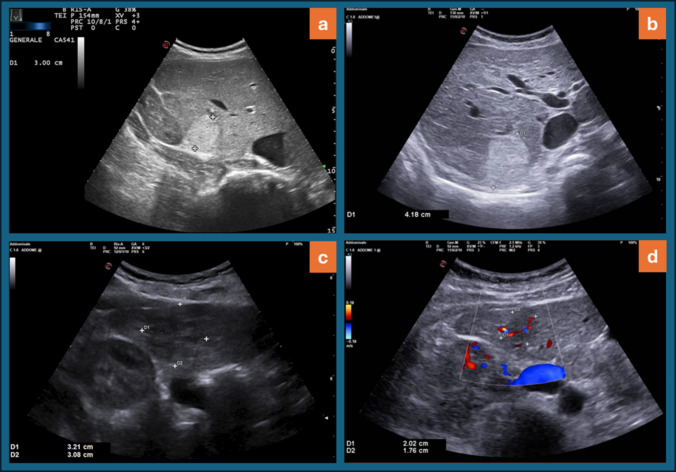 Evolution of focal nodular hyperplasia during long-term ultrasound follow-up: results from a single-center study.