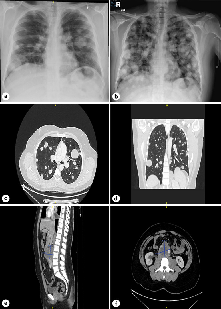 Remarkable Response to Cisplatin-Based Chemotherapy and Long-Term Remission in a Young Male with Widespread Extragonadal Choriocarcinoma: A Case Report and Literature Review.