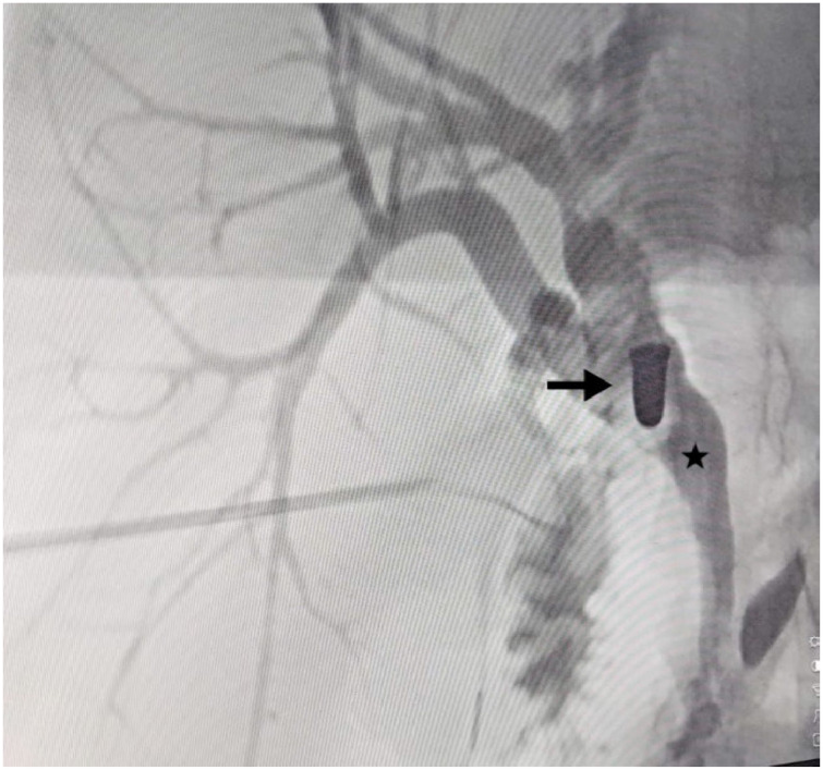 Management of obstructive jaundice induced by a retained bullet in the common hepatic duct: A case report.