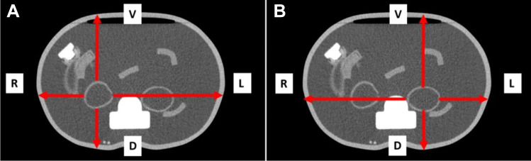 Development of a CT-less SPECT Acquisition Protocol for Kidney Dosimetry in <sup>177</sup>Lu-PSMA-617 Radioligand Therapy.
