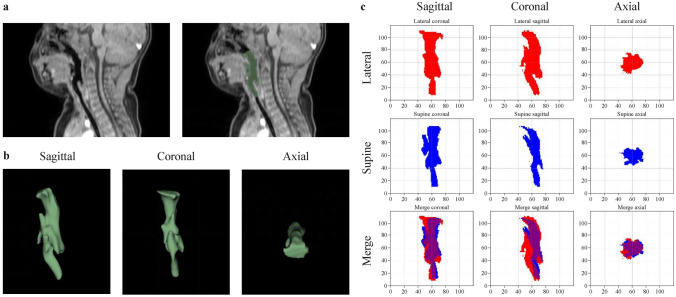Impact of lateral positioning on upper airway morphology in sedated children under five.