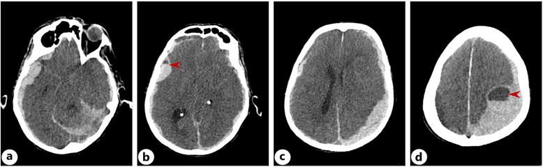 Neurological Immune-Related Adverse Events in Patients Treated with Anti-Programmed Death 1 Agent, Pembrolizumab: A Case Series.