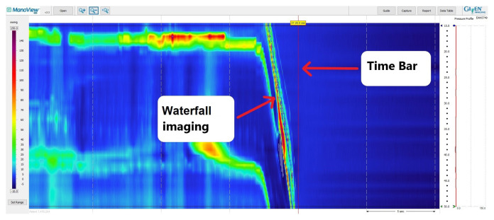 Thermal compensation algorithm in ManoScan™ high resolution esophageal manometry: does it really affect manometry metrics and final diagnosis?