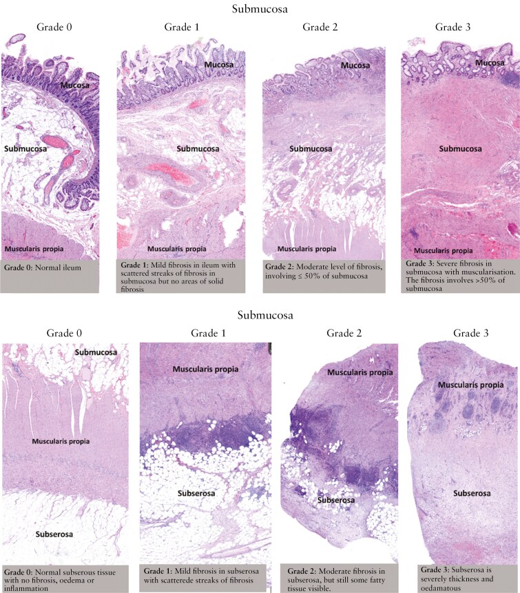 Serum biomarkers of collagen remodeling are associated with intestinal fibrosis and differentiate stenotic from luminal Crohn's disease patients: a pre- and post-resection longitudinal study.