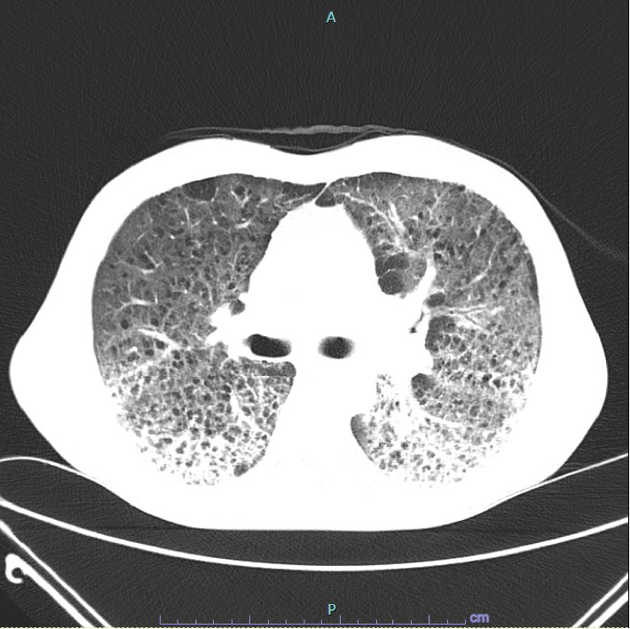 Mit-O-My I Can't Breath! Mitomycin C-Induced Pneumonitis Leading to Acute Respiratory Distress Syndrome, a Rare Case.