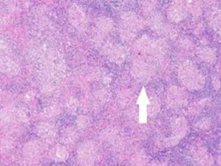Gastrointestinal sarcoidosis mimicking malignancy: A confusing scenario.