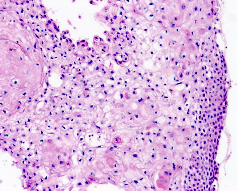 Squamous Cell Carcinoma: A Clinical and Histopathological Review of a South African Tertiary Dermatology Unit.