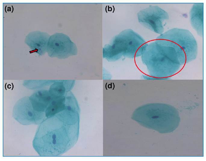 Cytogenetic Alterations Observed in Exfoliative Cells of the Tongue and Oral Mucosa of SARS-CoV-2-Vaccinated Patients: Report of Two Cases and a Brief Literature Review.