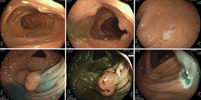 Familial adenomatous polyposis: non-surgical management of large bowel disease: endoscopic and chemoprevention strategies.