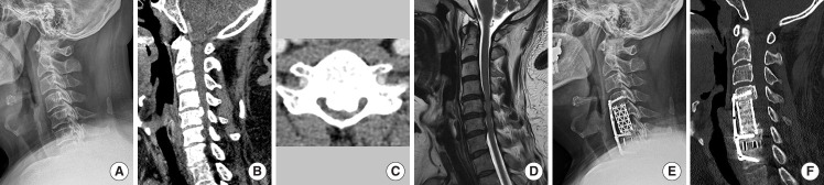 The Role of K-Line and Canal-Occupying Ratio in Surgical Outcomes for Multilevel Cervical Ossification of the Posterior Longitudinal Ligament: A Retrospective Multicenter Study.