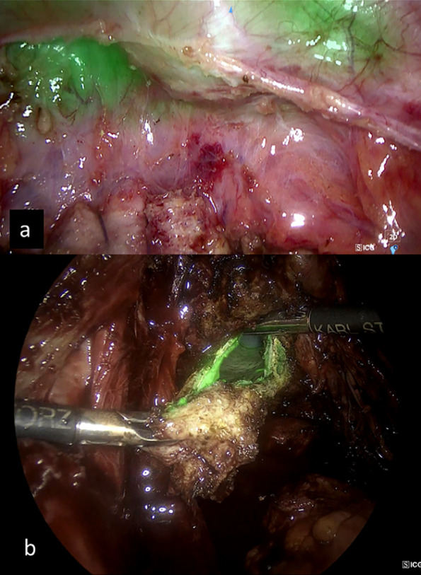Improving efficacy and safety of surgery in benign gynaecology: the case for indocyanine green.