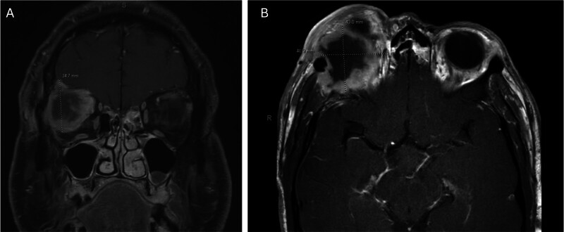 Carcinoma Ex-Pleomorphic Adenoma of the Lacrimal Gland with Intracranial Extension.
