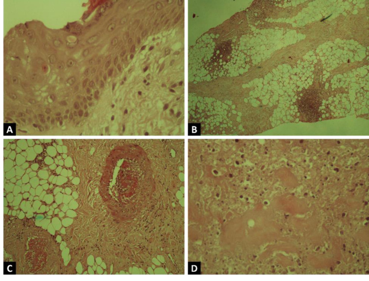 Pyoderma gangrenosum, as the first clinical presentation of systemic lupus erythematous, a case report and comprehensive literature review.