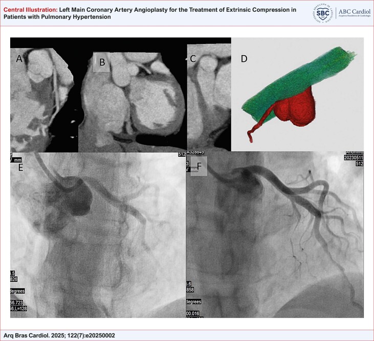 Left Main Coronary Artery Angioplasty for the Treatment of Extrinsic Compression in Patients with Pulmonary Hypertension.