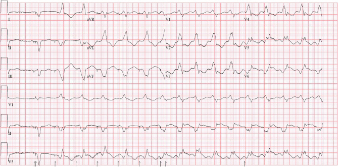 Midnight punctual tachycardia.