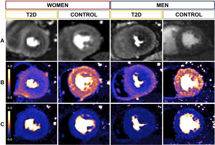 Sex differences and determinants of coronary microvascular function in asymptomatic adults with type 2 diabetes.