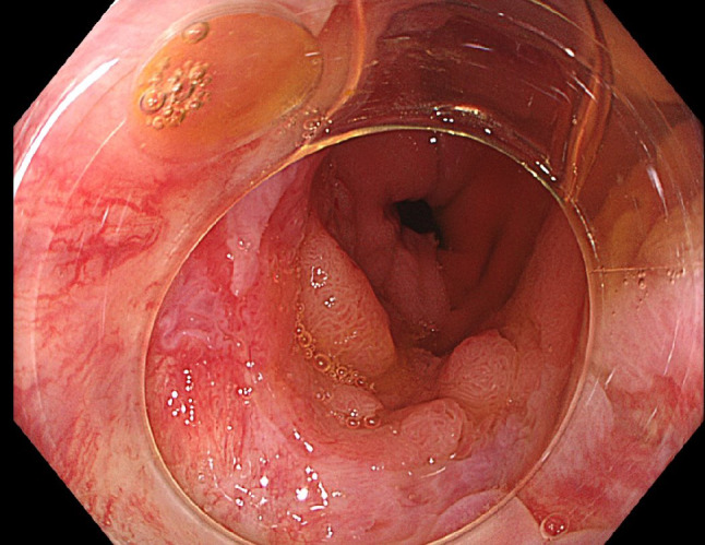 Familial adenomatous polyposis: non-surgical management of large bowel disease: endoscopic and chemoprevention strategies.