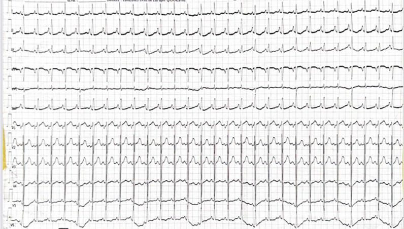Takotsubo cardiomyopathy due to a pheochromocytoma: a case report.