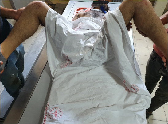 Bilateral anterior obturator hip dislocation without fracture: A rare case report with unusual etiology.