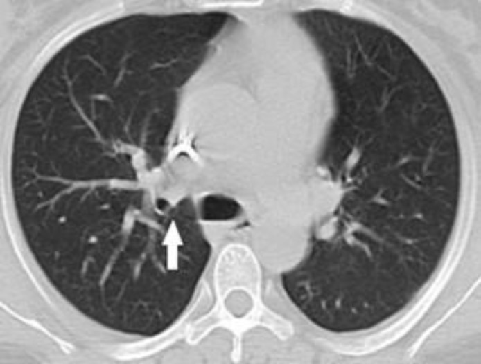 Gastrointestinal sarcoidosis mimicking malignancy: A confusing scenario.